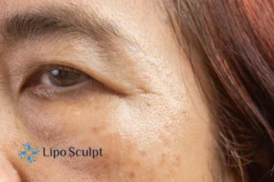 Cryopen: The Revolutionary Treatment for Age Spots Unveiled 2 Are age spots Stowmarket giving you low self esteem? Contact us today!