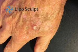 Best Actinic Keratoses Removal 2 Improve your wellbeing and health with Actinic Keratoses Stowmarket removal.treatment