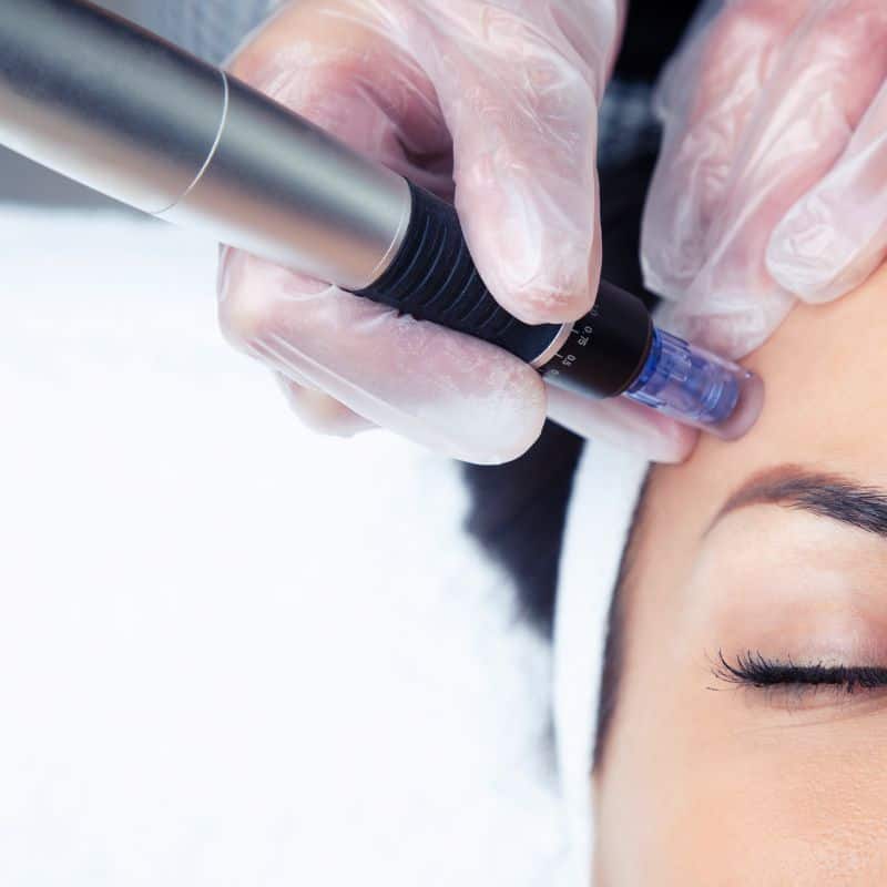 Morpheus8 treatment Stowmarket from Lipo Sculpt - Book in today!