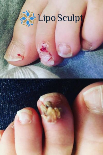 Wart removal customer results from Lipo Sculpt Stowmarket